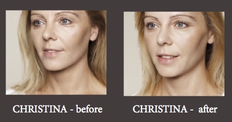 ermal_fillers_before_and_after